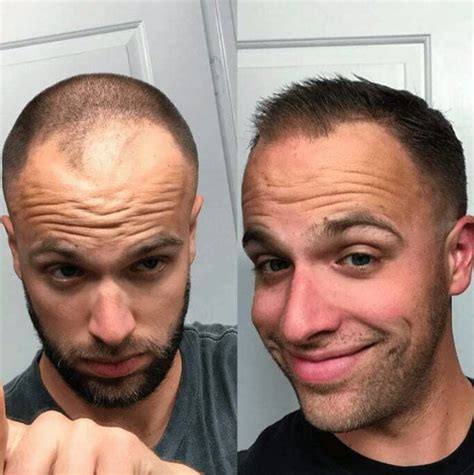 hims for men hair growth reviews